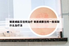 银屑病能否住院治疗 银屑病要住院一般采取什么治疗法