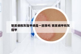 银屑病和灰指甲病是一回事吗 银屑病甲和灰指甲