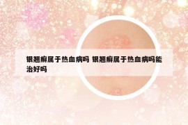 银翘癣属于热血病吗 银翘癣属于热血病吗能治好吗