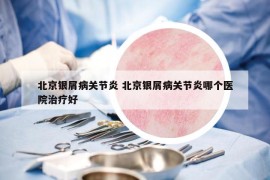 北京银屑病关节炎 北京银屑病关节炎哪个医院治疗好