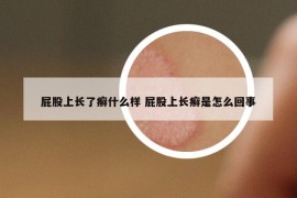 屁股上长了癣什么样 屁股上长癣是怎么回事