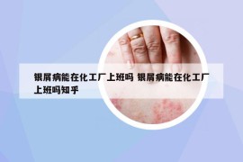 银屑病能在化工厂上班吗 银屑病能在化工厂上班吗知乎