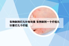 生物制剂打几针有效果 生物制剂一个疗程几针要打几个疗程