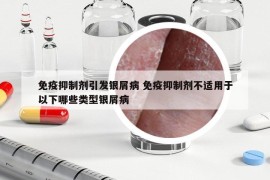 免疫抑制剂引发银屑病 免疫抑制剂不适用于以下哪些类型银屑病