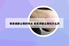 银屑病静止期的特点 银屑病静止期吃什么药