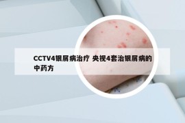 CCTV4银屑病治疗 央视4套治银屑病的中药方