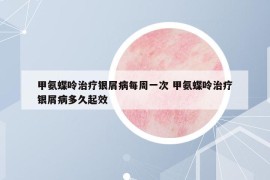 甲氨蝶呤治疗银屑病每周一次 甲氨蝶呤治疗银屑病多久起效