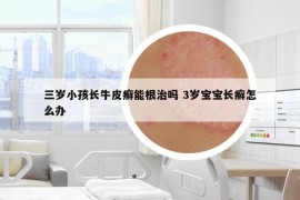 三岁小孩长牛皮癣能根治吗 3岁宝宝长癣怎么办