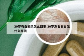 30岁有白癜风怎么回事 30岁左右有白发什么原因