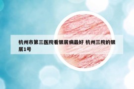 杭州市第三医院看银屑病最好 杭州三院的银屑1号