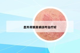 患外阴银屑病该咋治疗好