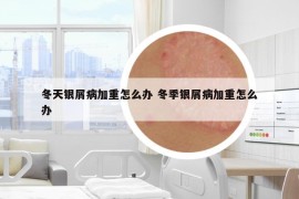 冬天银屑病加重怎么办 冬季银屑病加重怎么办