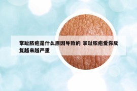 掌趾脓疱是什么原因导致的 掌趾脓疱爱你反复越来越严重