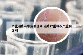 严重湿疹与牛皮癣区别 湿疹严重和不严重的区别