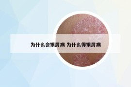 为什么会银屑病 为什么得银屑病