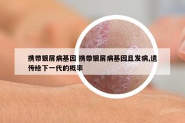 携带银屑病基因 携带银屑病基因且发病,遗传给下一代的概率