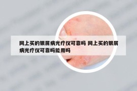 网上买的银屑病光疗仪可靠吗 网上买的银屑病光疗仪可靠吗能用吗