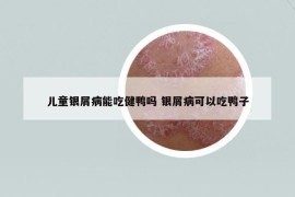 儿童银屑病能吃健鸭吗 银屑病可以吃鸭子