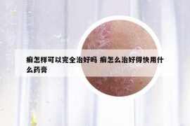 癣怎样可以完全治好吗 癣怎么治好得快用什么药膏