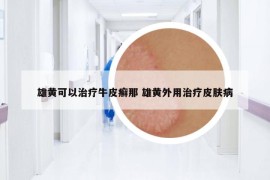 雄黄可以治疗牛皮癣那 雄黄外用治疗皮肤病