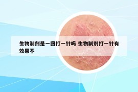 生物制剂是一回打一针吗 生物制剂打一针有效果不