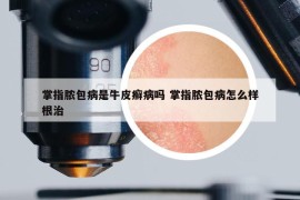 掌指脓包病是牛皮癣病吗 掌指脓包病怎么样根治