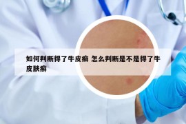 如何判断得了牛皮癣 怎么判断是不是得了牛皮肤癣