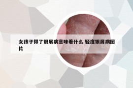 女孩子得了银屑病意味着什么 轻度银屑病图片