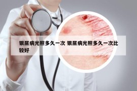 银屑病光照多久一次 银屑病光照多久一次比较好