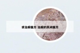 求治癣偏方 治癣的民间偏方