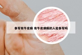 参军有牛皮癣 有牛皮病癣的人能参军吗