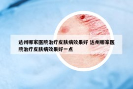 达州哪家医院治疗皮肤病效果好 达州哪家医院治疗皮肤病效果好一点