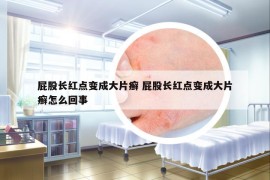 屁股长红点变成大片癣 屁股长红点变成大片癣怎么回事