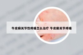 牛皮癣关节性疼痛怎么治疗 牛皮廨关节疼痛