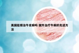 美国能根治牛皮癣吗 国外治疗牛癣的先进方法