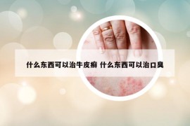 什么东西可以治牛皮癣 什么东西可以治口臭