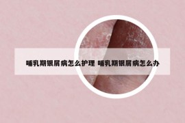 哺乳期银屑病怎么护理 哺乳期银屑病怎么办