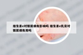 维生素e对银屑病有影响吗 维生素e乳膏对银屑病有用吗