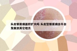 头皮银屑病面积扩大吗 头皮型银屑病会不会发展到其它地方