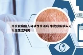 牛皮肤癣病人可以性生活吗 牛皮肤癣病人可以性生活吗男