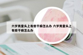 六岁男童头上有些干癣怎么办 六岁男童头上有些干癣怎么办