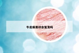 牛皮癣黑印会复发吗