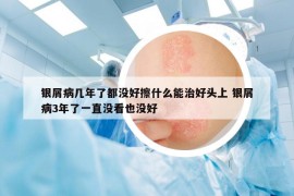 银屑病几年了都没好擦什么能治好头上 银屑病3年了一直没看也没好