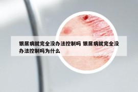 银屑病就完全没办法控制吗 银屑病就完全没办法控制吗为什么