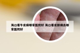 海口看牛皮癣哪家医院好 海口看皮肤病去哪家医院好