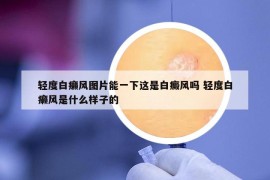 轻度白癞风图片能一下这是白癜风吗 轻度白癞风是什么样子的