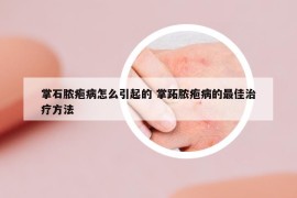 掌石脓疱病怎么引起的 掌跖脓疱病的最佳治疗方法