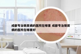 成都专治银屑病的医院在哪里 成都专治银屑病的医院在哪里好