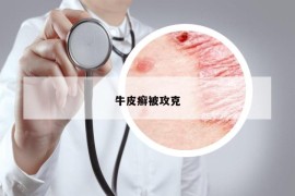 牛皮癣被攻克