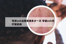 窄波uvb治银屑病多少一次 窄谱uvb光疗银屑病